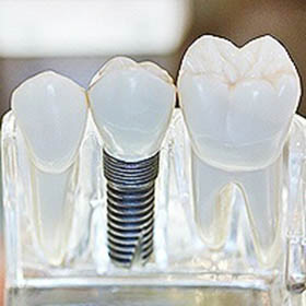 Dental Implants Woodland Hills